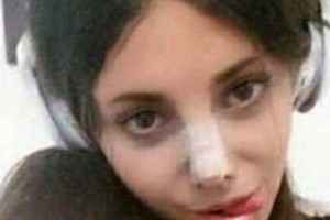19-летней девушки из Ирана изуродовала себя в погоне стать похожей на Анджелину Джоли