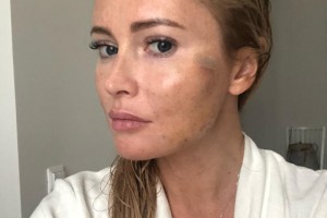 Дана Борисова о последствиях омоложения: «С утра все лицо разбухло...»  